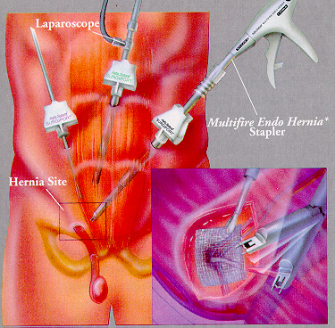 hernia treatment,Inguinal hernia repair surgery, causes, by Alisa kansakar, All Treatment
